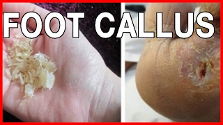 How to Prevent Calluses and What Cause Callus on Feet