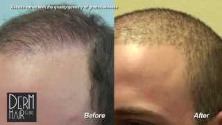 Los Angeles FUE Hair transplant : Buzz cut after body hair transplant and strip scar repair.