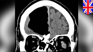 Doctors find air pocket in man's brain - TomoNews