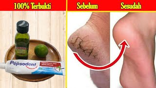 CARA PALING AMPUH MENGATASI TUMIT KAKI PECAH-PECAH SECARA ALAMI || MENGATASI TUMIT KAKI PECAH PECAH