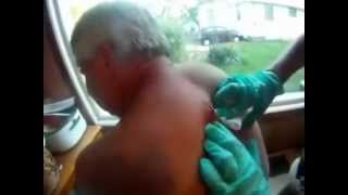 самый большой прыщ в мире(Biggest pimple in a world)