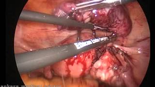 ushaqliqdan kenar hamilelik , Boru hamileliyi , laparoskopiya , ectopic pregnancy
