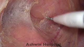 Laparoscopic low AR step by step with voice over in male pt
