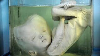 Топ 8 людей с самыми шокирующими физическими аномалиями