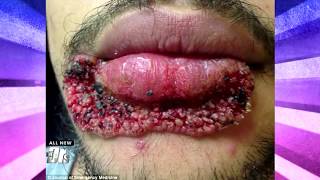 Find out Why You Should Think Twice about Popping That Zit!