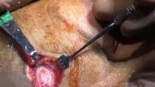 Frontal Bone Osteoma Removal