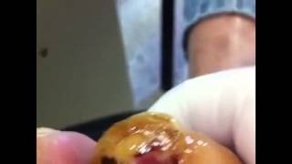 Ulcera diabética neuropatica tratada con AGHO