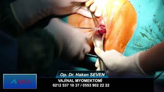 Vajinal Myomektomi / Op. Dr. Hakan SEVEN