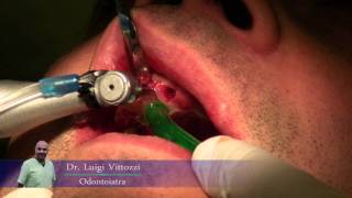 Implantologia dentale con il Dr. Luigi Vittozzi