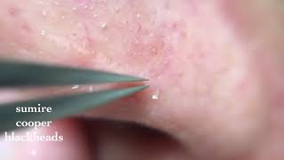 鼻角栓117nose blackheads★Tweezers only★