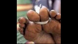 Female Genital Mutilation