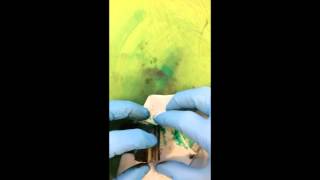 Radical prostatectomy