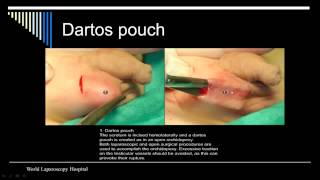 Laparoscopic Assisted Orcheopexy for Undescended Testes