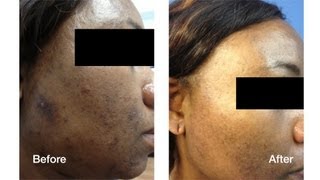 Dark Skin Laser Skin Care Treatments | Skin Perfect Brothers in Walnut, CA