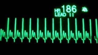 Atrial Tachycardia