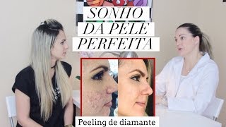 PEELING DE DIAMANTE - ANTES E DEPOIS