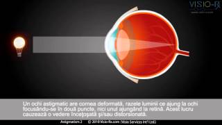 Astigmatismul pe intelesul tuturor.
