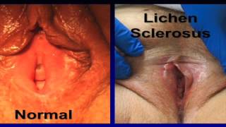 Vulvar Dermatologic Conditions 7 minute version
