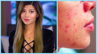 Surprise BREAKOUT! Skincare Routine