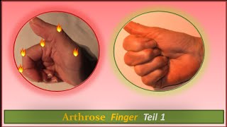 Arthrose Finger Teil 1