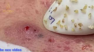 TREATMENT BLACKHEADS (90) | Loan Nguyen