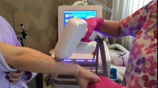 Epilare definitiva cu diode laser