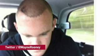 Wayne Rooney reveals hair transplant results
