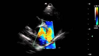Colour Doppler Echocardiography