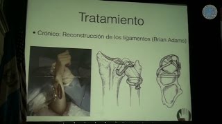 "Secuelas Radiocubitales en Fracturas de Radio Distal"