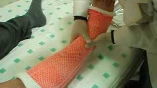 Leg cast