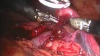 Robotic Pyeloplasty