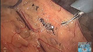Laparoscopic partial D2-gastrectomy master class