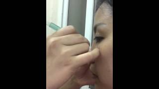 Máy hút mụn osole- cách hút mụn hiệu quả