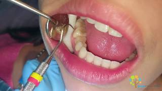 Molar Cavity Filling with Composite