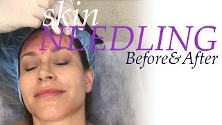 Skin Needling Before and After