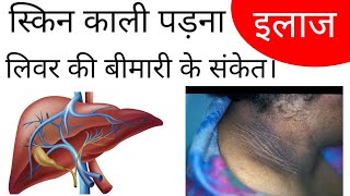 HOW TO MANAGE THE DARKNESS OF THE SKIN? by Dr. Manoj Das
