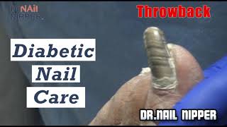 Diabetic Nail Care - Clipper, Medicool Drill, Currette [Thursday Throwback]