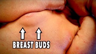 BABY BOY with BREAST BUDS | Dr. Paul
