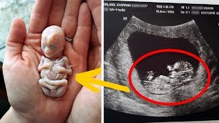 6 Weeks After This Mother Gave Birth, Doctors Found A Deadly Unborn Baby Growing Inside Her