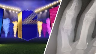 FIFA 18 | I BROKE MY FINGER... BUNDESLIGA TOTS PACK OPENING