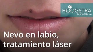 Nevo en labio, tratamiento láser (16124)