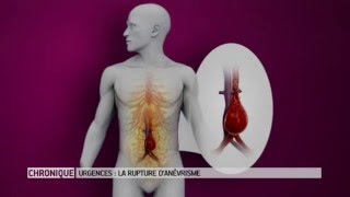 La rupture d'anévrisme : une urgence absolue - Le Magazine de la santé
