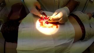CYST EXTRACTION