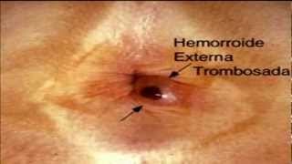 almorranas-las hemorroides tratamiento