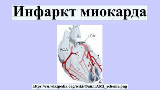 Инфаркт миокарда