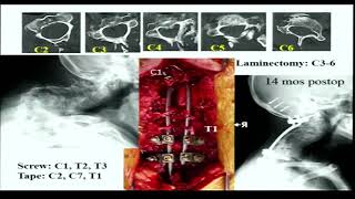 Talk on Correction of Craniocervical& cervical deformities in Sagittal and coronal planes