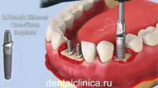 Лечение зубов красивая улыбка коронки протезирование импланты СГС Швейцария с абатмантом