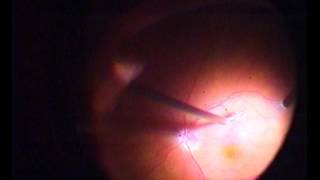 Surgery Retinal. Удаление ВПМ через кольцо Вейса.