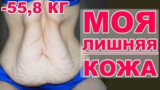 Обвисшая кожа после похудения // Лишняя кожа после похудения // Что с моей кожей