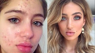 Model Belle Lucia Reveals Incredible Acne Transformation